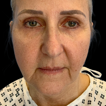 before-lip-lift